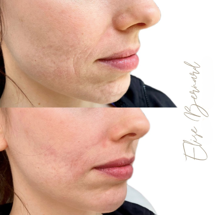 Nose to mouth lines correction